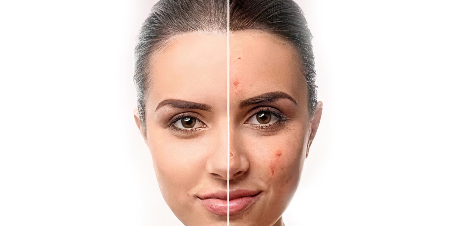 کوکتل مزوتراپی ضد لک