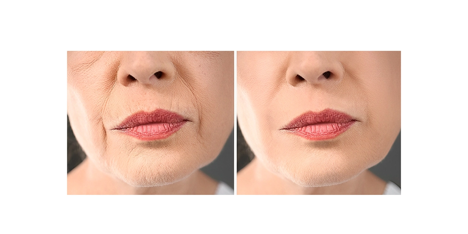 کوکتل مزوتراپی جوانساز