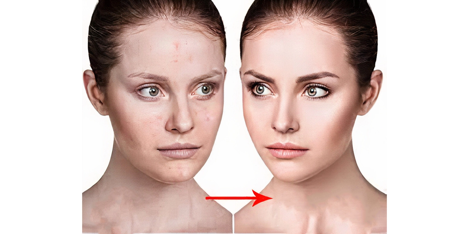 کوکتل مزوتراپی ضد لک