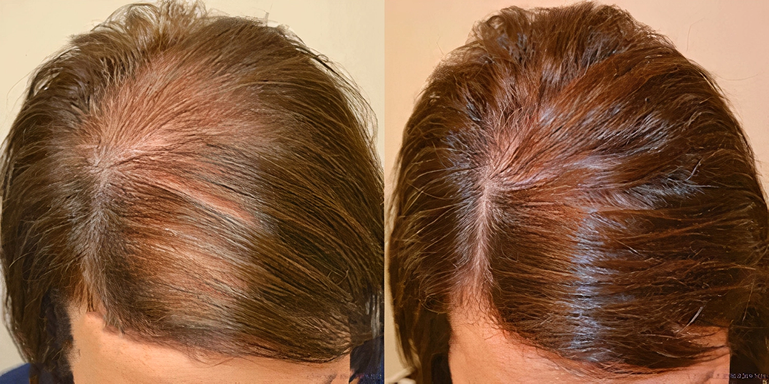 کوکتل مزوتراپی مو