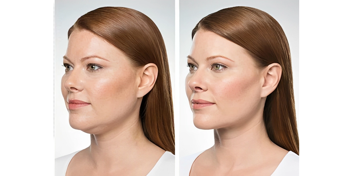 کوکتل مزوتراپی چربی سوز