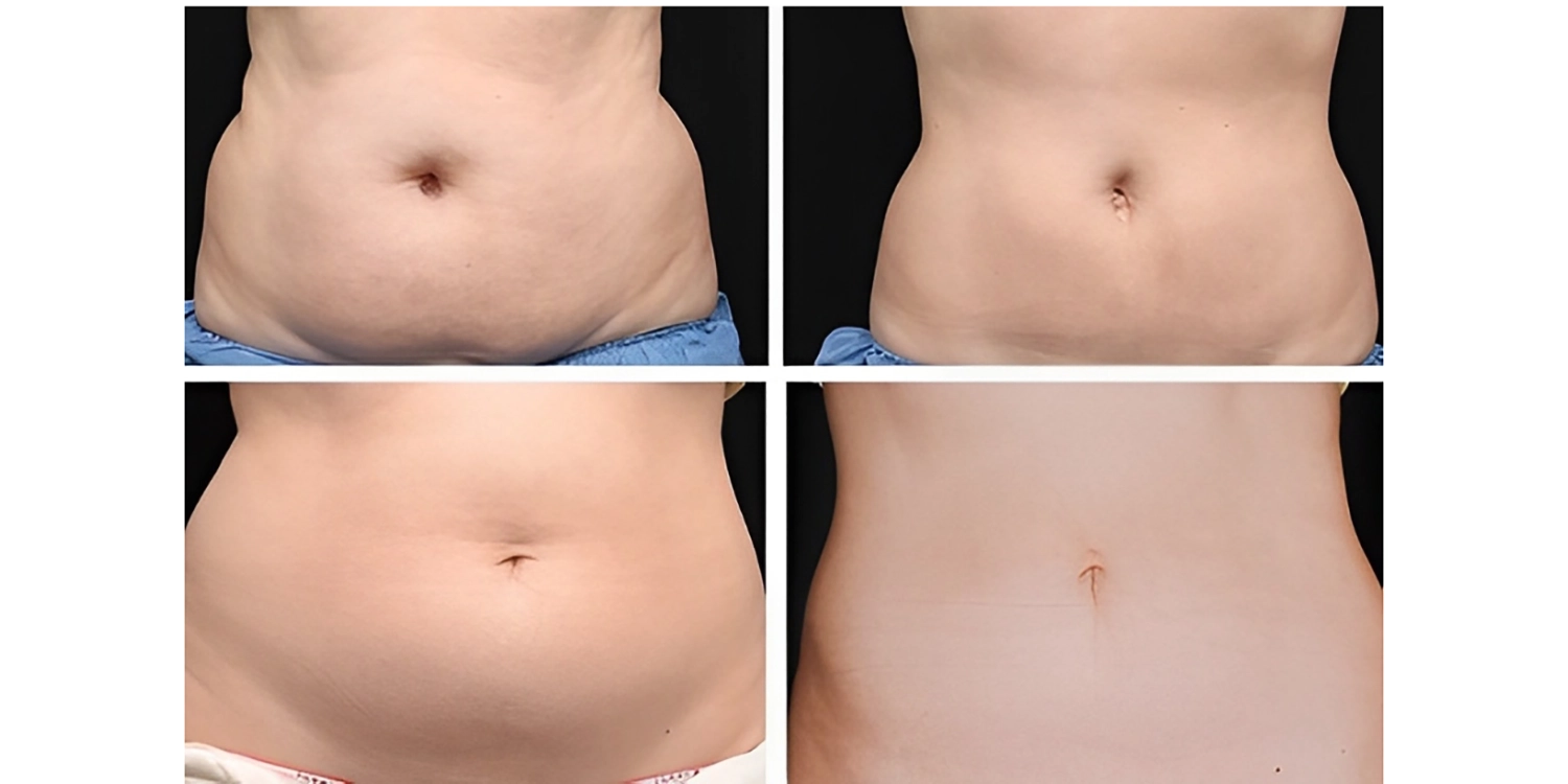 کوکتل مزوتراپی چربی سوز