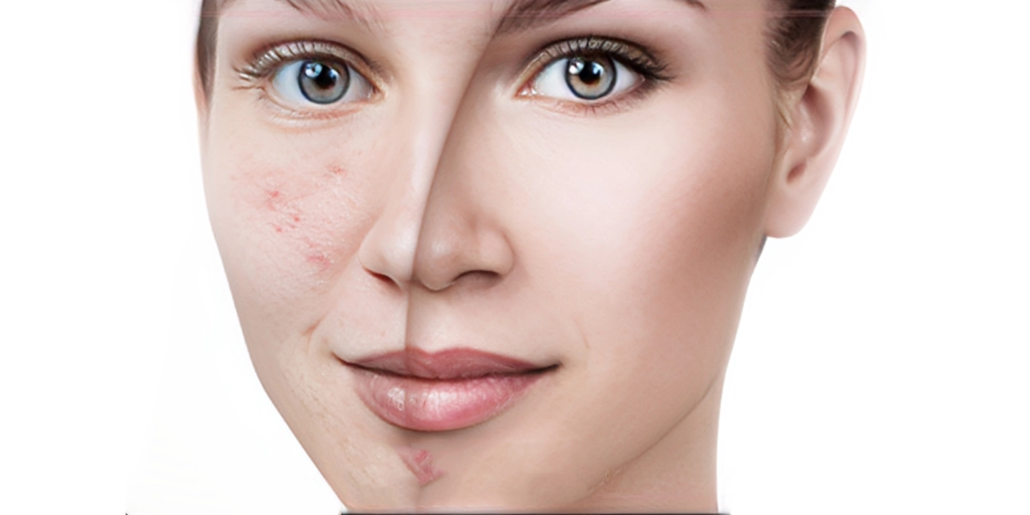 درمان اسکار و جای جوش با محصولات BCN